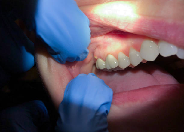 Best Chipped Tooth Repair Near Me  in Amherst, WI